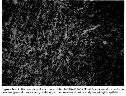 Biopsia Pleural