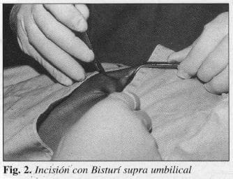Incisióri'con Bisturí supra umbilical