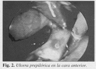 Ulcera prepilórica en la cara anterior