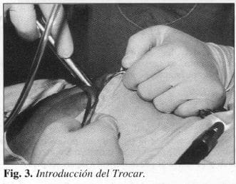 Introducción del Trocar