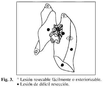 Lesión Resecable Lesión Resecable