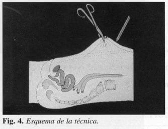 Esquema de la técnica