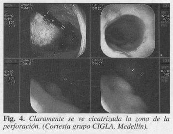 Zona de la Perforación