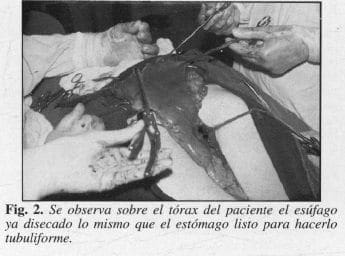 Paciente el Esófago ya disecado Paciente el Esófago ya disecado