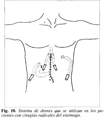 Sistema de Drenes Sistema de Drenes