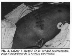 Lavado y Drenaje de la cavidad Retroperitoneal Lavado y Drenaje de la cavidad Retroperitoneal