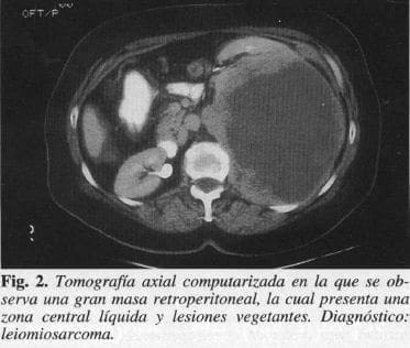 Masa Retroperitoneal, la cual presenta una Zona Central Líquida Masa Retroperitoneal, la cual presenta una Zona Central Líquida