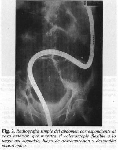 Abdomen, Colonoscopio Flexible a lo largo del Sigmoide Abdomen, Colonoscopio Flexible a lo largo del Sigmoide