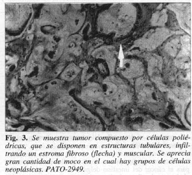 Tumor Compuesto por Células Poliédricas