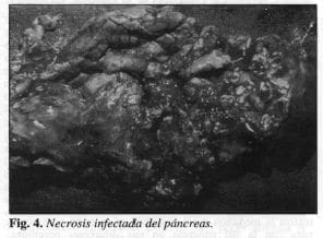 Necrosis Infectada del Páncreas Necrosis Infectada del Páncreas