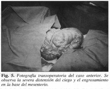 Severa Distensión del Ciego y el Engrosamiento en la Base del Mesenterio Severa Distensión del Ciego y el Engrosamiento en la Base del Mesenterio
