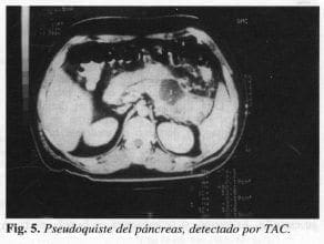 Pseudoquiste del páncreas, detectado por TAC Pseudoquiste del páncreas, detectado por TAC