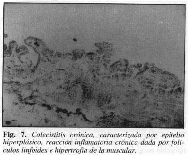 Colecistitis Crónica