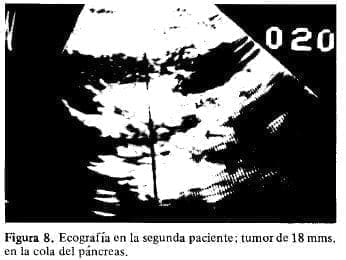 Tumor de 18 mms. en la Cola del Páncreas Tumor de 18 mms. en la Cola del Páncreas