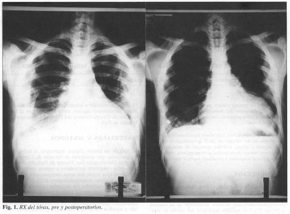 RX del tórax, pre y postoperatorios
