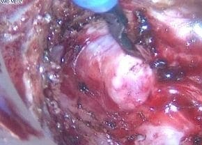 Disección abdominal