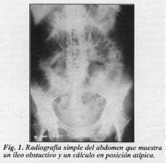 Íleo obstuctivo y un cálculo