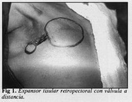 Expansor tisular retropectoral