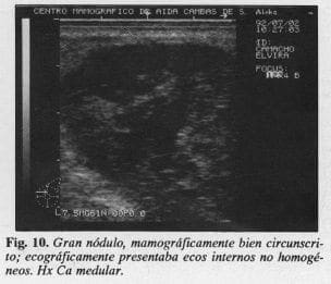 Gran nódulo, Mamográficamente bien circunscrito Gran nódulo, Mamográficamente bien circunscrito