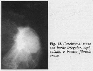 Carcinoma: masa con borde irregular Carcinoma: masa con borde irregular