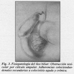 Obstrucción vesicular