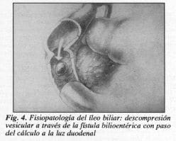 Fisiopatología del íleo biliar
