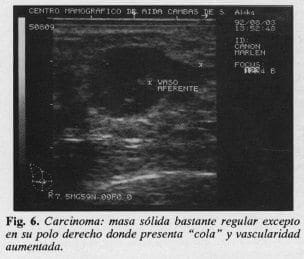Carcinoma Carcinoma