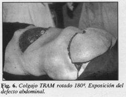 Colgajo TRAM rotado 180