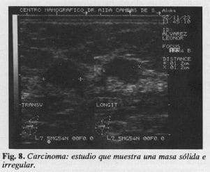 Carcinoma: Estudio que muestrauna masa sólida e irregular