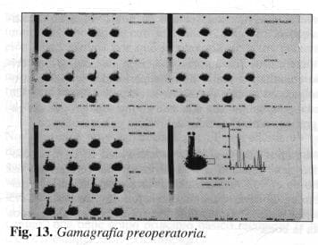 Gamagrafía preoperatoria