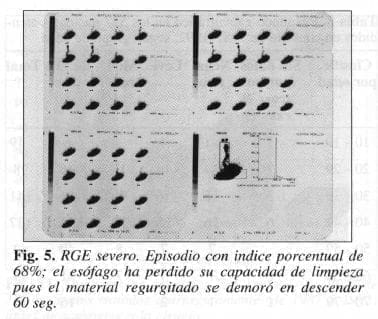 RGE severo