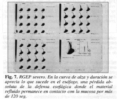 RGEP severo