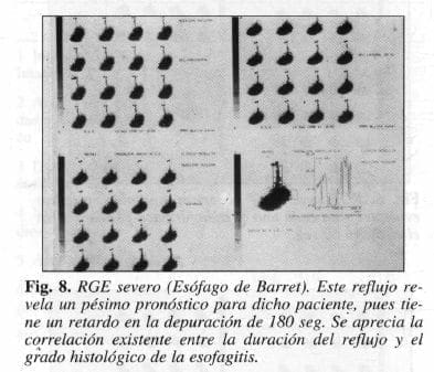 Esófago de Barret