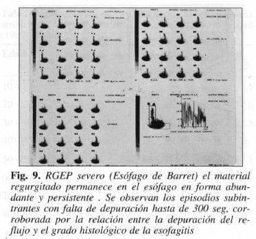 Esófago de Barret