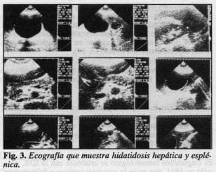 Hidatidosis hepática y esplénica