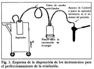 Perfeccionamiento de la reinfusión