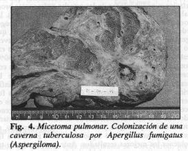 Micetoma pulmonar