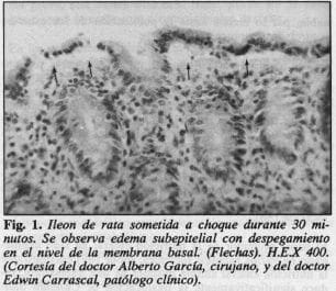 Edema subepitelial