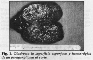 Superficie esponjosa y hemorrágica de un paraganglioma Superficie esponjosa y hemorrágica de un paraganglioma