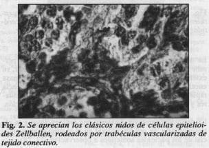 Nidos de células epitelioides Nidos de células epitelioides