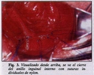 Anillo inguinal interno