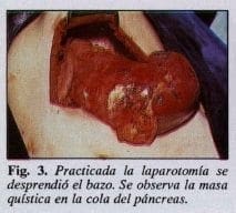 Masa quística en la cola del páncreas