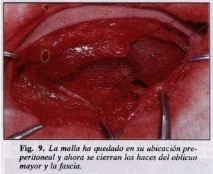 Haces del oblicuo mayor y la fascia