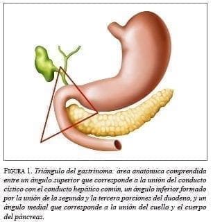 Triángulo del gastrinoma