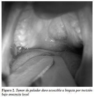 Tumor de paladar duro