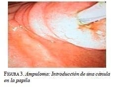 Ampuloma