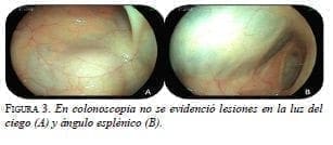 Colonoscopia