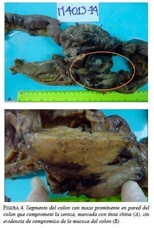 Segmento del colon con masa