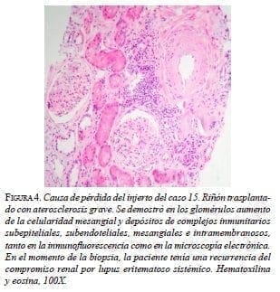 Riñón trasplanta­do con aterosclerosis grave
