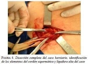 Disección completa del saco herniario